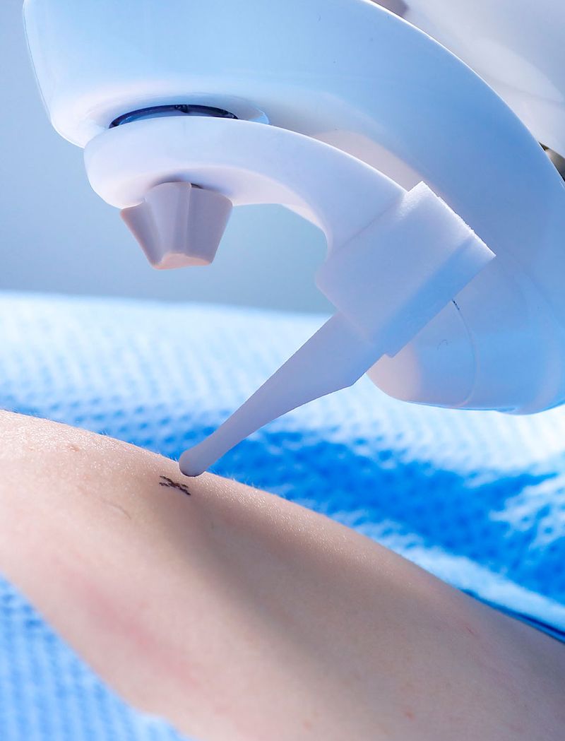 Needle placement system